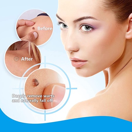 Rensz Skin Tag Remover: The Safe and Effective Way to Remove Skin Tags