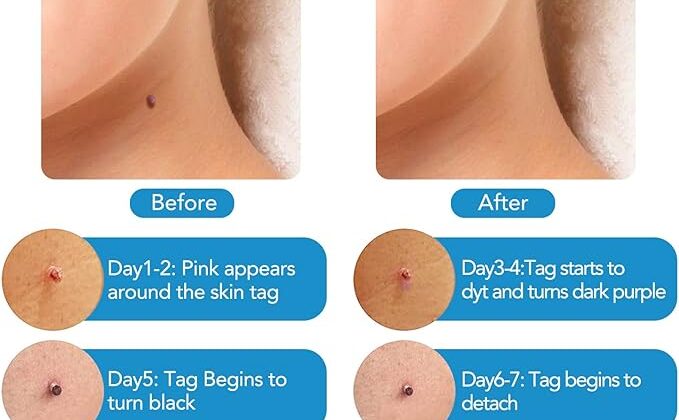 Lovells Skin Tag Remover: Fast And Effective Tag Remover!